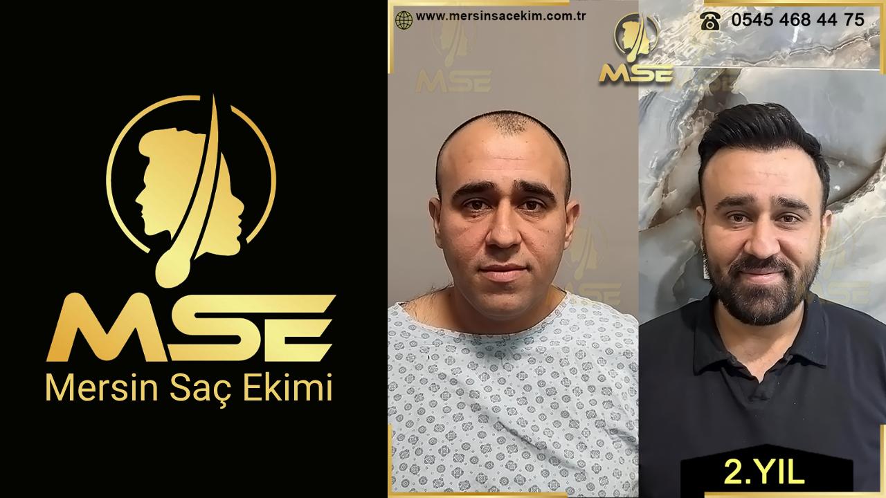 MERSİN SAÇ EKİMİ